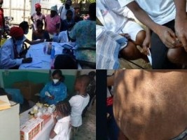 Haïti - Santé : Le Gouvernement mobilisé contre une infection cutanée très contagieuse...