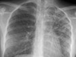 Haïti - Santé : Le pays à le plus haut taux de tuberculose des Amériques
