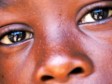 Haïti - Santé : Opérations chirurgicales gratuites des yeux, les cubains dans le Sud-Ouest